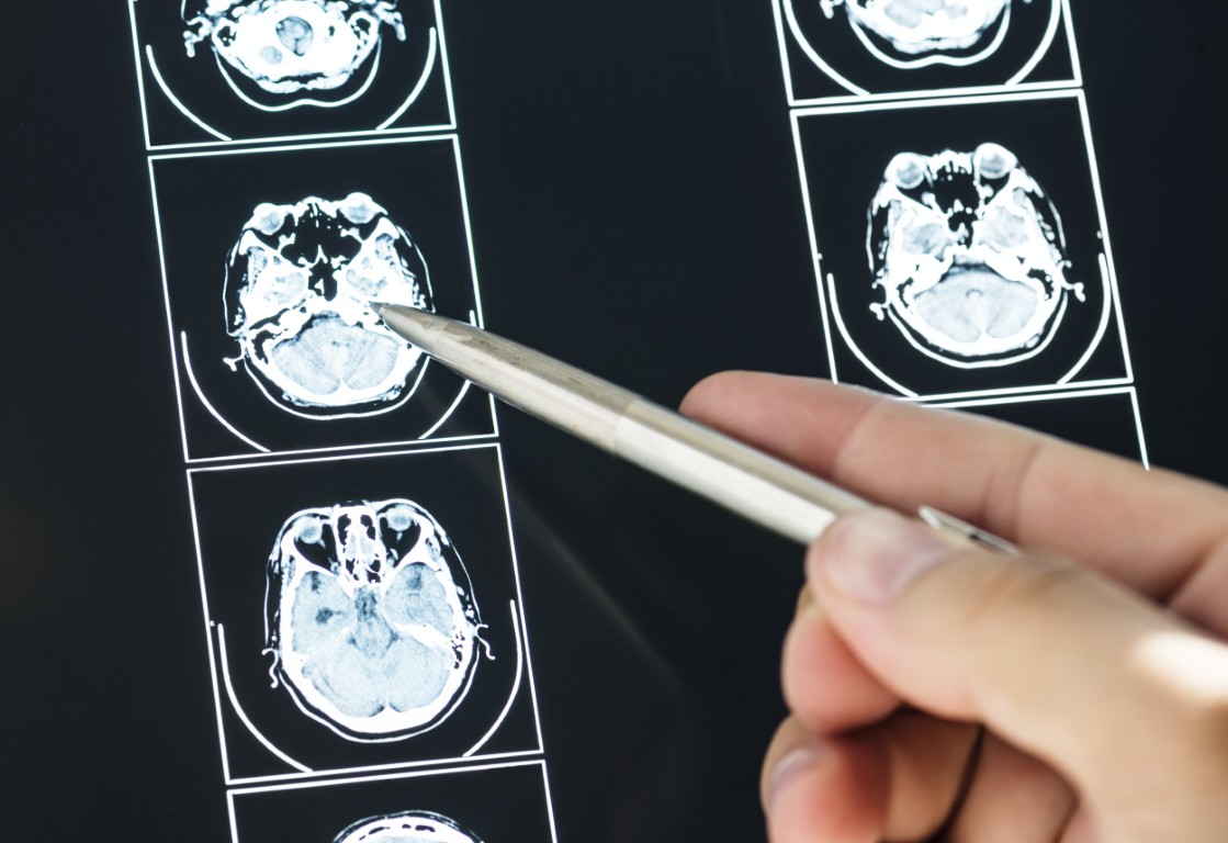 Neurocirugía